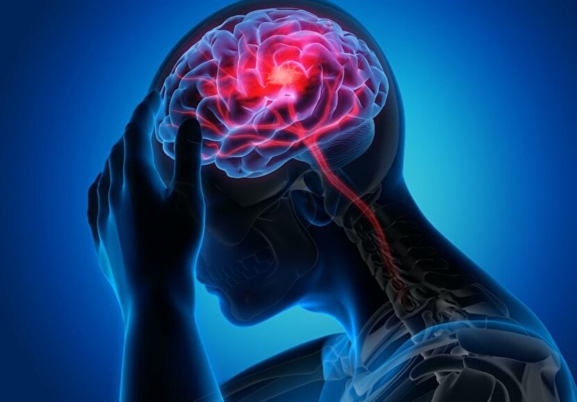 ابتلای ۱.۴ میلیون ایرانی به صرع/ میگرن شایع‌ترین نوع سردرد